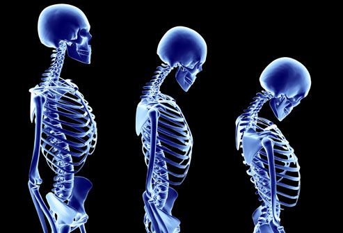 Mencegah Osteoporosis (pengeroposan tulang) Sejak Dini