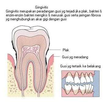 JANGAN REMEHKAN RADANG GUSI