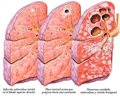 Fenomena Gunung Es Tuberkulosis