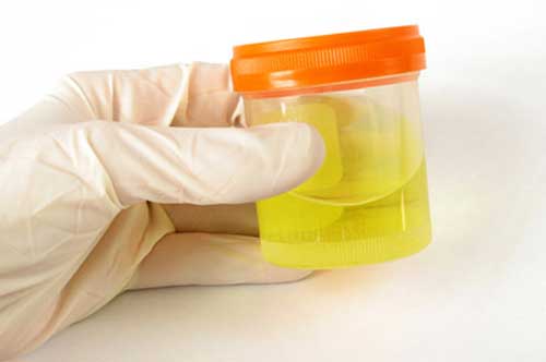 Pemeriksaan  Urine, Sederhana Namun Penuh Makna