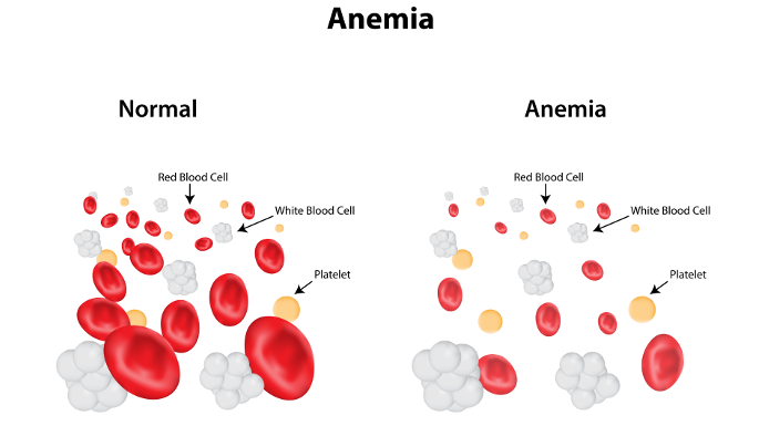 Pengaruh Anemia Pada Ibu Hamil