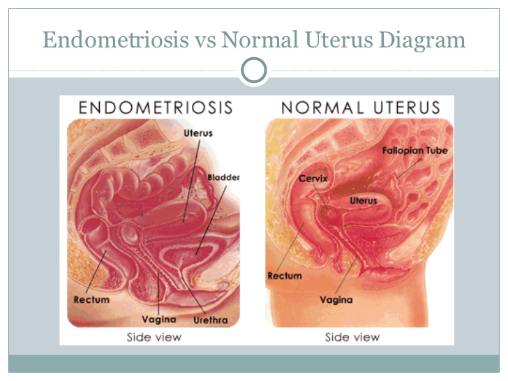 Endometriosis (Kista Coklat)